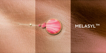 Melasyl – Giải pháp hoàn hảo cho vấn đề nám da sau 18 năm nghiêm cứu của L’Oréal
