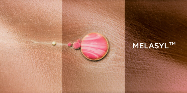 Melasyl – Giải pháp hoàn hảo cho vấn đề nám da sau 18 năm nghiêm cứu của L’Oréal